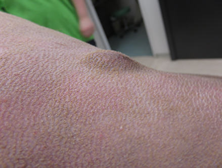 Tumor unter der Haut